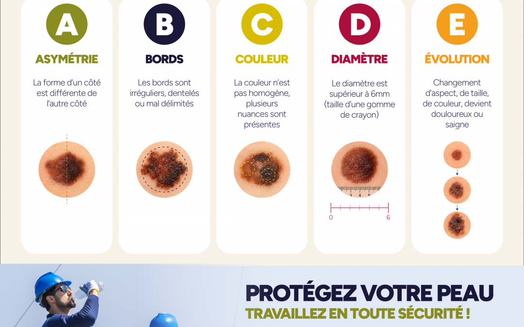 Travail au soleil : surveillez vos grains de beauté !