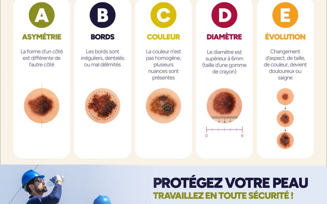 Travail au soleil : la règle ABCDE pour surveiller sa peau